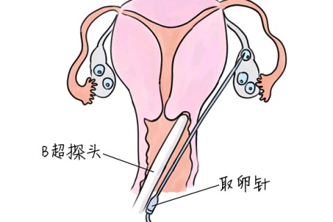了解剖腹产后的经阴道分娩